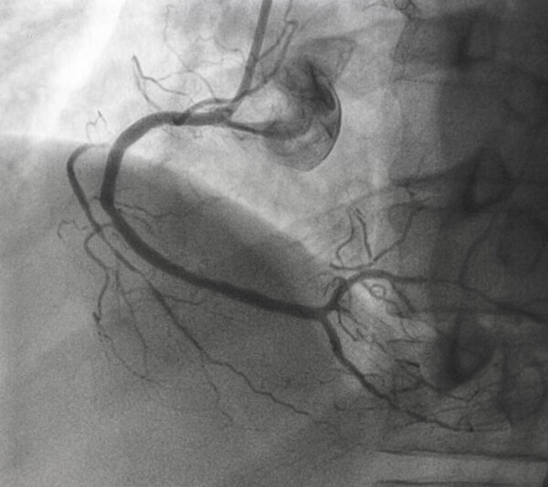 Коронарная ангиография, правая коронарная ангиография