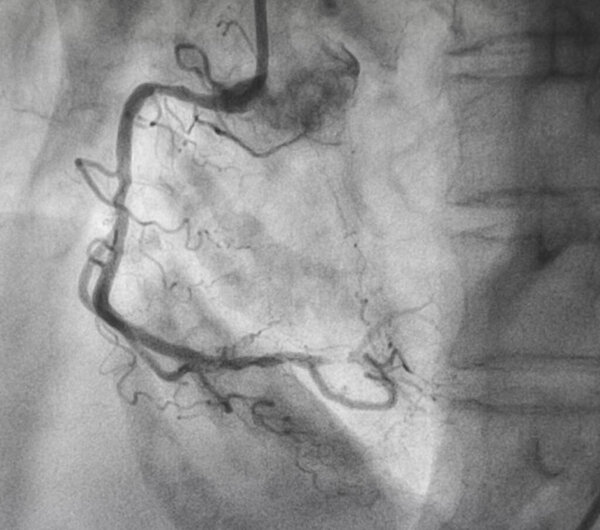 Коронарная ангиография, правая коронарная ангиография
