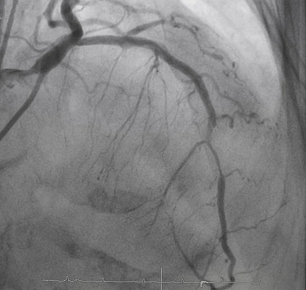 Angiografia Wieńcowa Angiografia Lewostronna — Zdjęcie stockowe