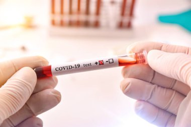 Koruyucu eldivenli eller laboratuardaki kovid 19 virüsünün bulaştığı kan örneğini test tüpüne koyuyor. Üst görünüm.