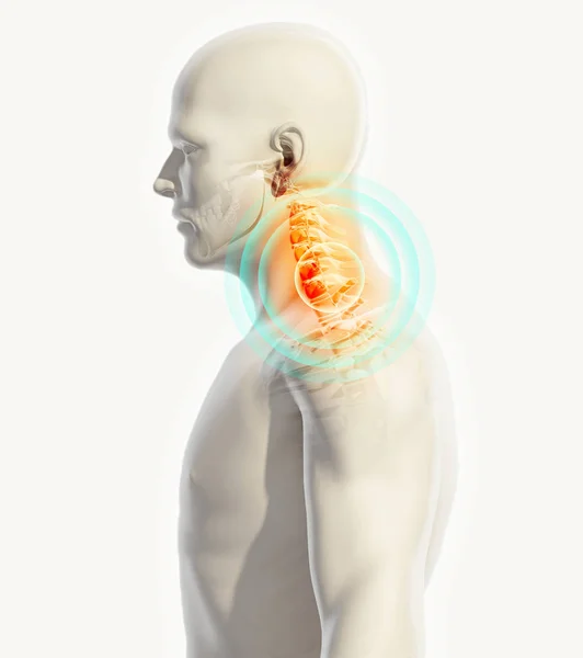 Krku bolestivé - kostra rentgen páteře cervica, 3d ilustrace. — Stock fotografie