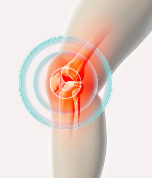 Knie pijnlijke - skelet x-ray. — Stockfoto