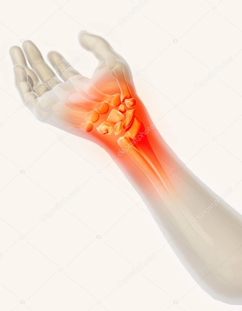 Wrist painful - skeleton x-ray.