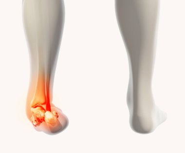 Ayak bileği acı - iskelet x-ray.