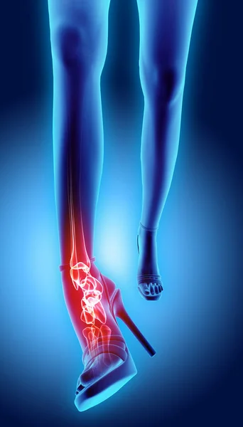Ankle high heeled painful - skeleton x-ray. — Stock Photo, Image