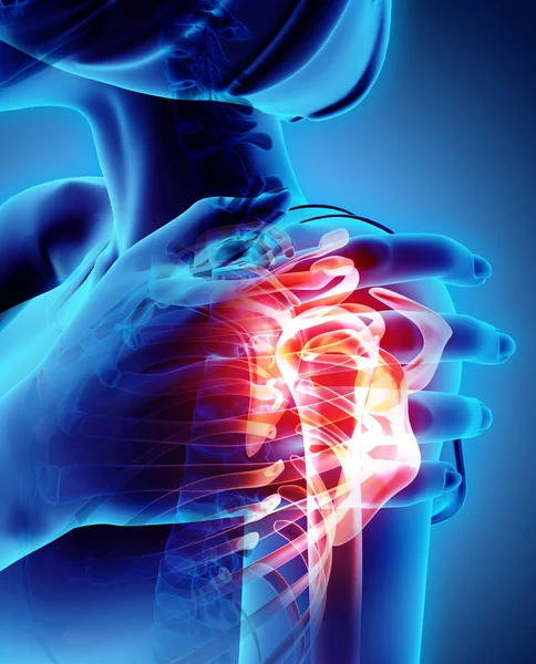 Shoulder painful skeleton x-ray, 3D illustration. — Stock Photo, Image