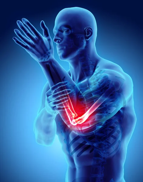 3D απεικόνιση του ανθρώπινου αγκώνα τραυματισμών. — Φωτογραφία Αρχείου