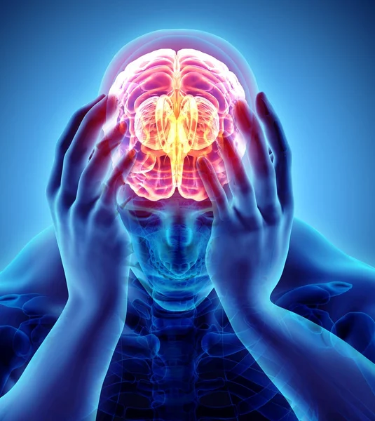3D illustration av huvudvärk mänskliga. — Stockfoto