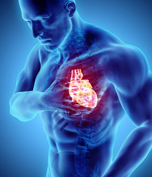 3d иллюстрация сердечного приступа человека . — стоковое фото