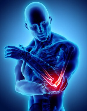 3D illüstrasyon insan dirsek yaralanma.