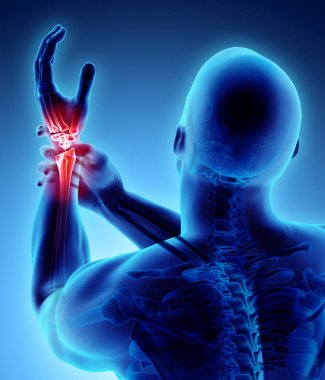 Bilek acı - iskelet x-ray.