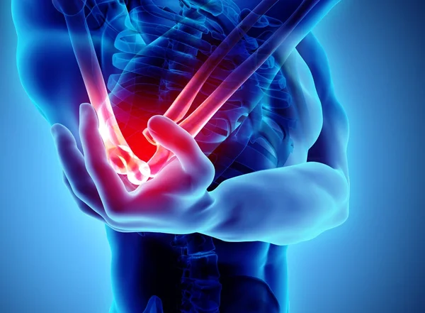 3D απεικόνιση του ανθρώπινου αγκώνα τραυματισμών. — Φωτογραφία Αρχείου
