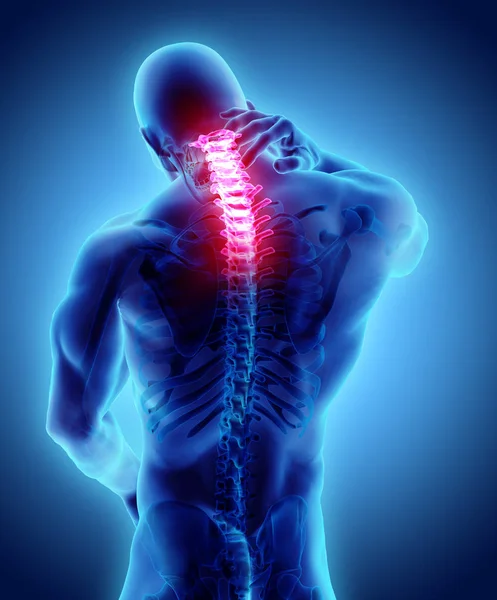 颈部疼痛骨架 x 射线，3d 图. — 图库照片