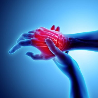 Palm acı - iskelet x-ray, tıp kavramı.