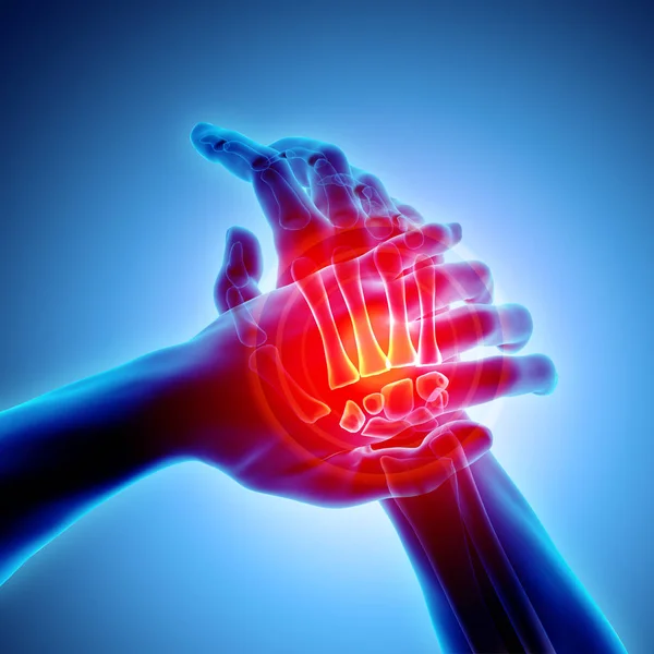 Palm pijnlijke - skelet x-ray, medische concept. — Stockfoto