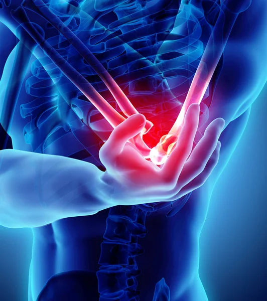 3d illustration of human elbow injury. — Stock Photo, Image