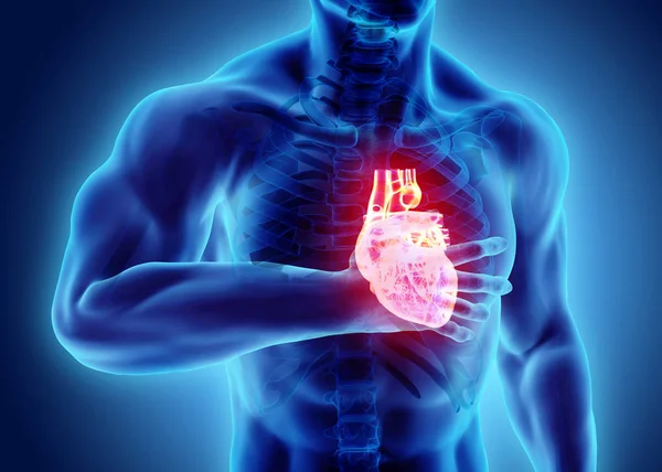 3D ilustracja ludzki atak serca. — Zdjęcie stockowe