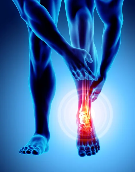Ayak bileği acı - iskelet x-ray.