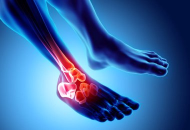 Ayak bileği acı - iskelet x-ray.