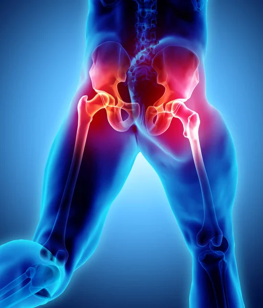 Radiografía del esqueleto doloroso de la cadera, ilustración 3D . —  Fotos de Stock
