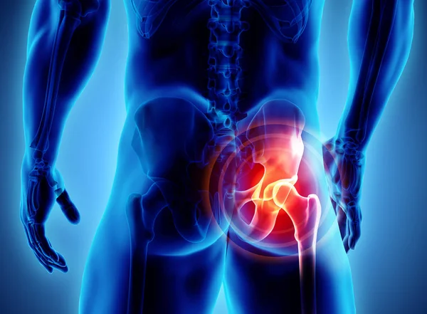 Raggi X dello scheletro dolorosi dell'anca, illustrazione 3D . — Foto Stock