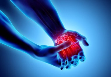 Palm acı - iskelet x-ray, tıp kavramı.