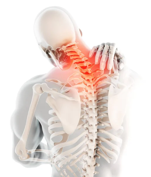 Ilustrasi Sakit Leher Tulang Belakang Serviks Rangka Ray Konsep Medis — Stok Foto