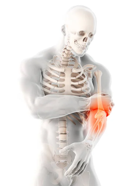 人体肘伤的图示 医学概念 — 图库照片