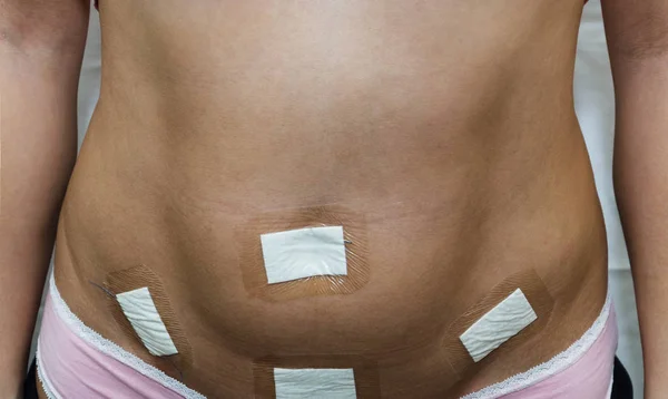 Belly of a young woman after laparoscopy surgery. White background. The abdomen is sealed with a patch after surgery to remove the ovarian cyst by laparoscopy in a clinic. Dressings for laparoscopic wounds.