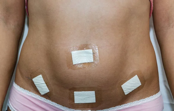 Ventre Une Jeune Femme Après Une Laparoscopie Fond Blanc Abdomen — Photo