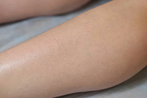 Um pedaço de pele na perna com pêlos crescidos. Antes do processo — Fotografia de Stock