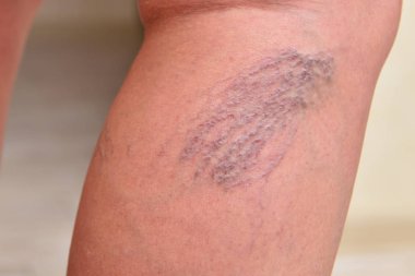 Diz ve baldırlarda kadın bacaklarında varis damarları var. Yakın plan.