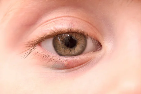 Children's right eye and swollen barley on the lower eyelid