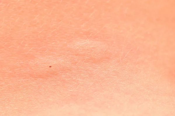 Geschwollene Haut Nach Einem Mückenstich Blasen Der Stelle Des Mückenstichs — Stockfoto