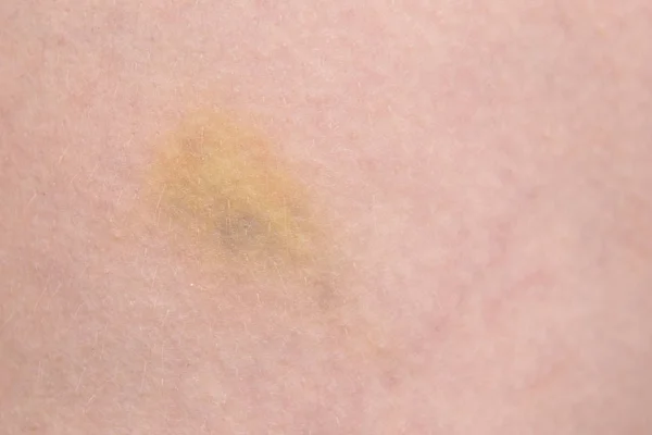 Gezwollen Huid Een Muggenbeet Blaren Verschenen Plaats Van Muggenbeet — Stockfoto