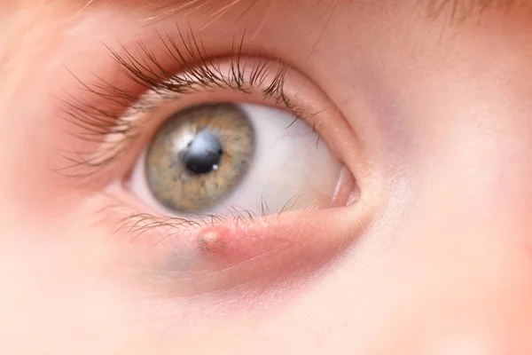 Kinderrechtes Auge Und Geschwollene Gerste Unteren Augenlid — Stockfoto