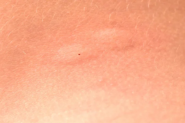 Geschwollene Haut Nach Einem Mückenstich Blasen Der Stelle Des Mückenstichs — Stockfoto