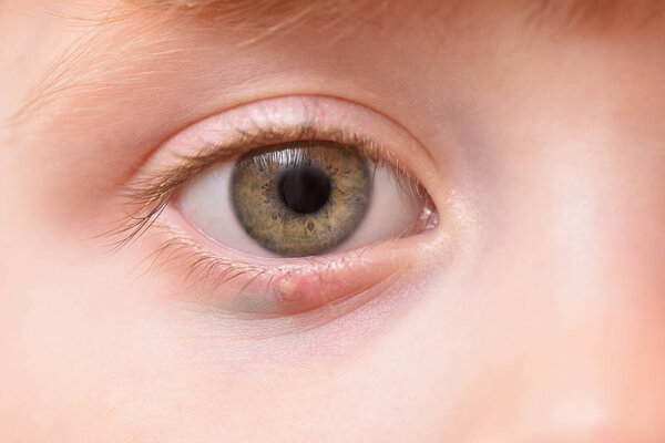 Children's right eye and swollen barley on the lower eyelid