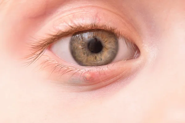 儿童右眼和下眼睑肿大的大麦 — 图库照片
