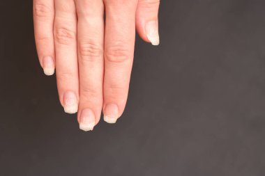 Yırtılmış ve kırılmış tırnaklar, jel tırnakların sökülmesi ve doğal tırnakların dökülmesi. Jel tırnaklardan sonra. 