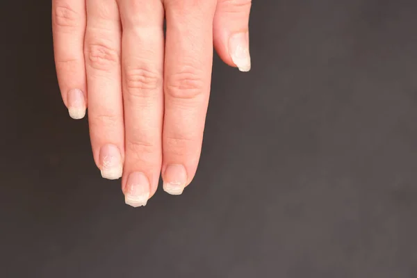 Clavos Arrancados Rotos Desprendimiento Uñas Gel Delaminación Uñas Naturales Después — Foto de Stock