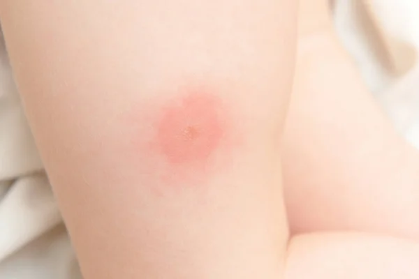 Kind Met Muggenbeet Been Jeuk Roodheid Wond Krassen — Stockfoto