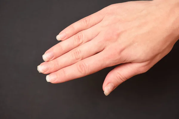 Clavos Arrancados Rotos Desprendimiento Uñas Gel Delaminación Uñas Naturales Después —  Fotos de Stock