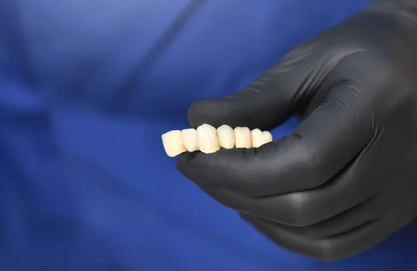 Dental bridge in the hands of a dentist. Close-up