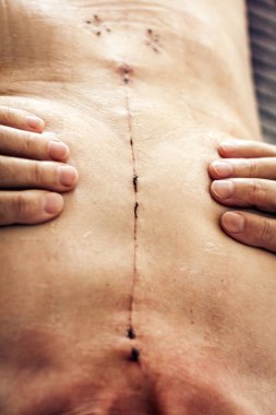 Kadın vücudunda açık kalp ameliyatından kalan yara.