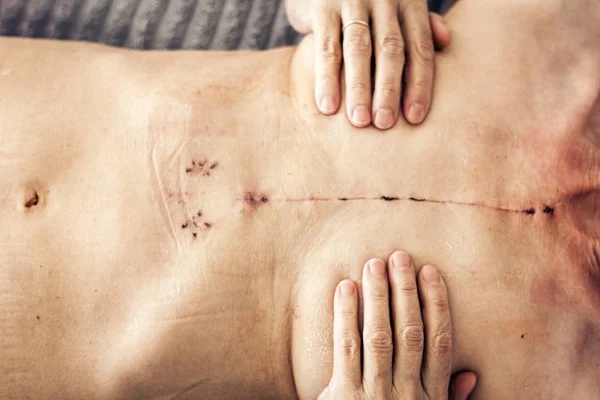Scar from open heart surgery on the female body, where the stern