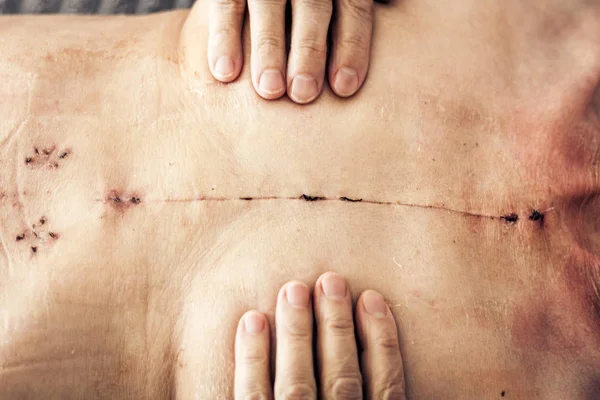 Scar from open heart surgery on the female body, where the stern