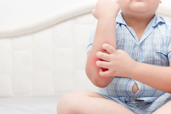 Zwaarlijvige vet jongen krassen op de jeuk met hand zijn arm — Stockfoto