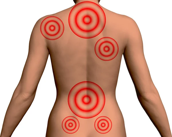 Realistische rug van een slank meisje met rode cirkels op de pijnpunten van de rug. Een 3D. Vectorillustratie — Stockvector