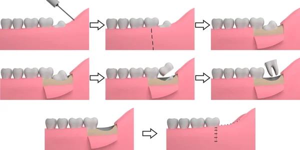 Yirmilik diş çıkarma, 3D işleme, kolaj, beyaz arkaplan